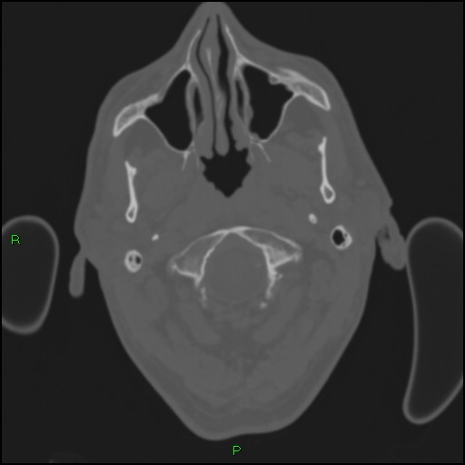 Cerebral contusions (Radiopaedia 33868-35039 Axial bone window 6).jpg