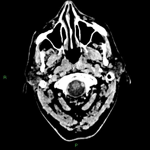 Cerebral contusions (Radiopaedia 33868-35039 Axial non-contrast 5).jpg