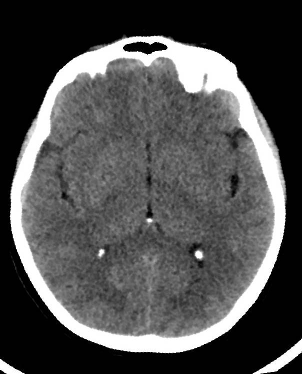 Cerebral edema due to severe hyponatremia (Radiopaedia 89826-106938 Axial non-contrast 51).jpg