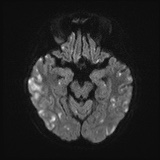 Cerebral embolic infarcts (embolic shower) (Radiopaedia 72391-82921 Axial DWI 41).jpg