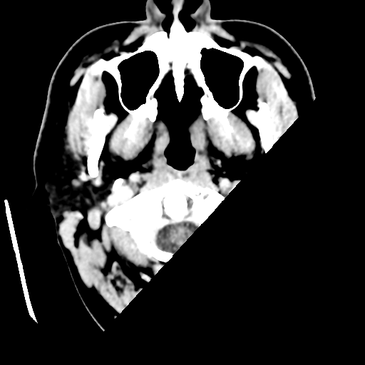 Cerebral hemorrhage secondary to arteriovenous malformation (Radiopaedia 33497-34561 B 2).png