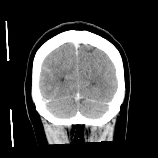 Cerebral hemorrhage secondary to arteriovenous malformation (Radiopaedia 33497-34561 C 57).png