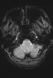 File:Cerebral hemorrhagic contusions- temporal evolution (Radiopaedia 40224-42757 D 3).png
