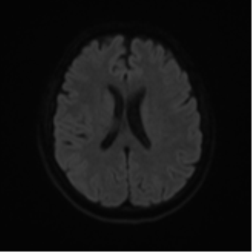 Cerebral metastases mimicking abscesses (Radiopaedia 45841-50131 Axial DWI 46).png