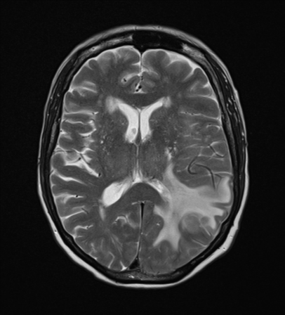 File:Cerebral metastasis (Radiopaedia 46744-51248 Axial T2 15).png