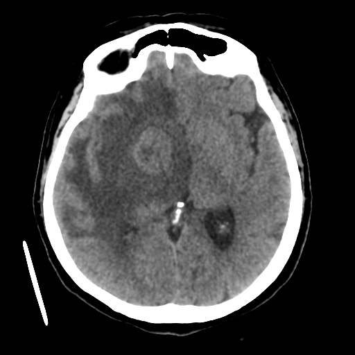 Cerebral metastasis to basal ganglia (Radiopaedia 81568-95412 Axial non-contrast 32).png