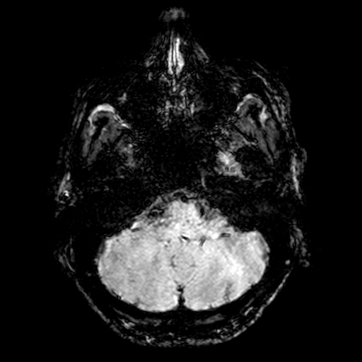 Cerebral parenchymal arteriovenous malformation (Radiopaedia 27280-27456 Axial SWI 11).jpg