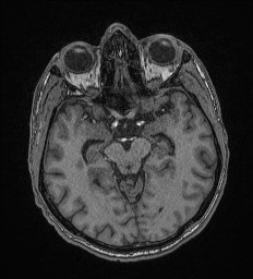 Cerebral toxoplasmosis (Radiopaedia 43956-47461 Axial T1 30).jpg