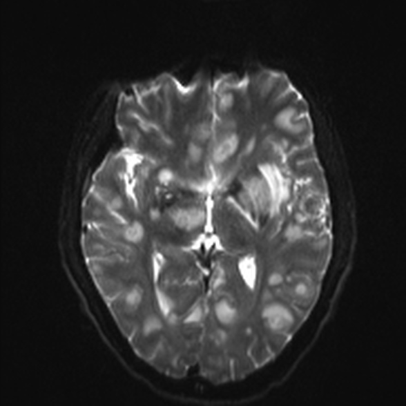 File:Cerebral toxoplasmosis (Radiopaedia 53993-60132 Axial DWI 13).jpg