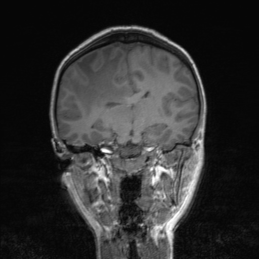Cerebral tuberculosis with dural sinus invasion (Radiopaedia 60353-68090 Coronal T1 100).jpg