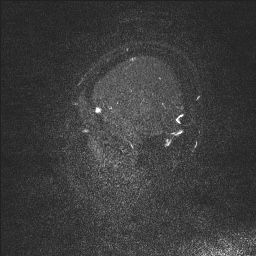 Cerebral tuberculosis with dural sinus invasion (Radiopaedia 60353-68090 Sagittal MRV 7).jpg