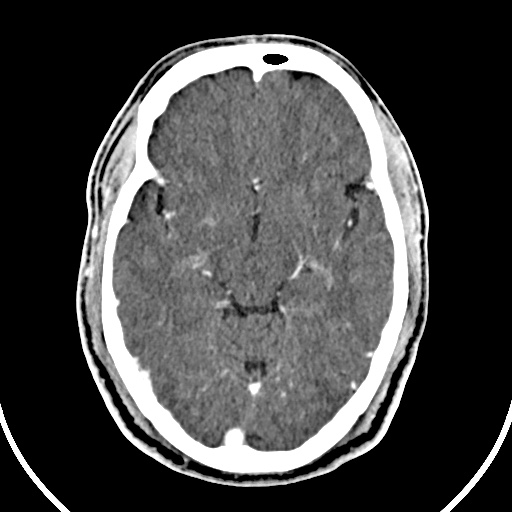 Cerebral venous angioma (Radiopaedia 69959-79977 B 33).jpg