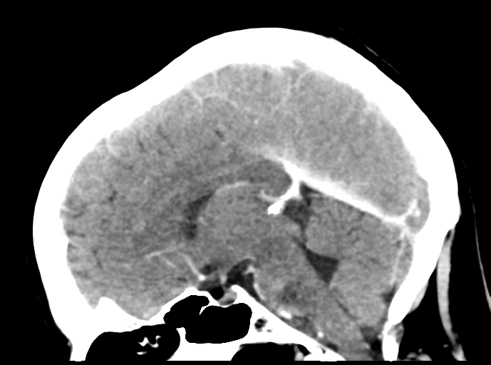 Cerebral venous hemorrhagic infarction (Radiopaedia 57576-64538 Sagittal C+ 27).png