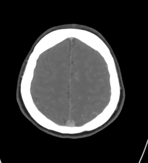 File:Cerebral venous infarction due to transverse sinus thrombosis (Radiopaedia 34688-36120 Axial CT venogram 40).png