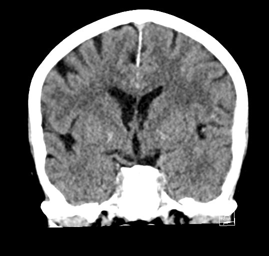 Cerebral venous infarction with hemorrhage (Radiopaedia 65343-74381 Coronal non-contrast 23).jpg