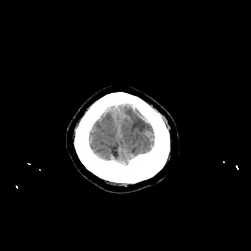 File:Cerebral venous throbmosis - hemorrhagic venous infarction (Radiopaedia 87318-103613 Axial non-contrast 167).jpg