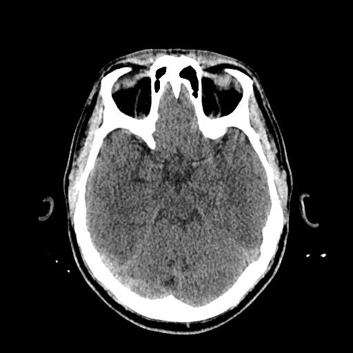 File:Cerebral venous thrombosis (CVT) (Radiopaedia 77524-89685 Axial non-contrast 18).jpg