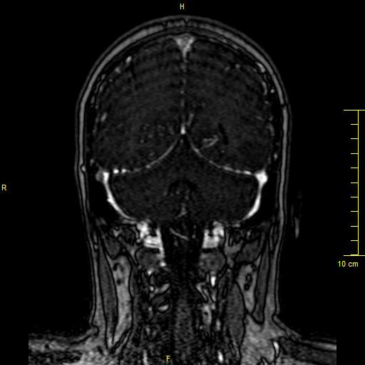 File:Cerebral venous thrombosis (Radiopaedia 23288-23351 MRV 121).JPG