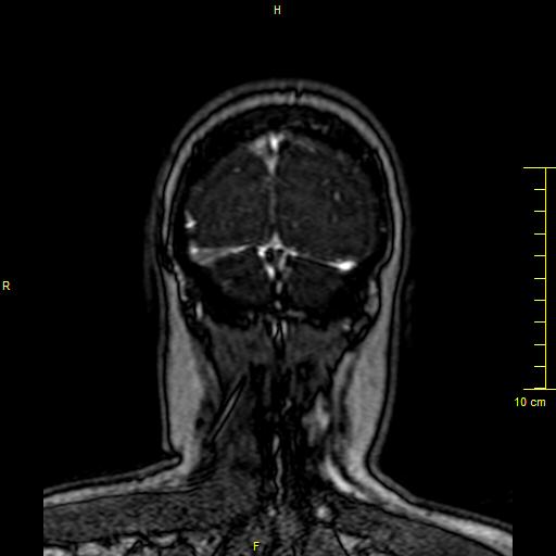 Cerebral venous thrombosis (Radiopaedia 23288-23351 MRV 163).JPG