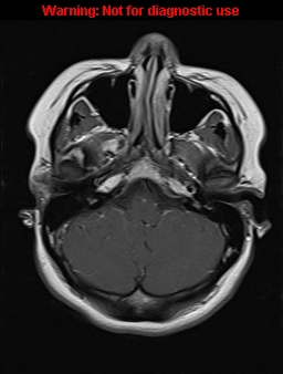 File:Cerebral venous thrombosis (Radiopaedia 37224-39208 Axial T1 C+ 5).jpg