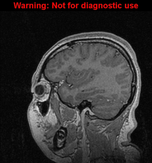 File:Cerebral venous thrombosis (Radiopaedia 37224-39208 Sagittal T1 C+ 113).jpg