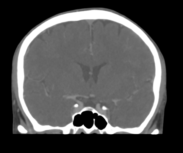 Cerebral venous thrombosis (Radiopaedia 38392-40467 Coronal CTA-Venogram 27).png