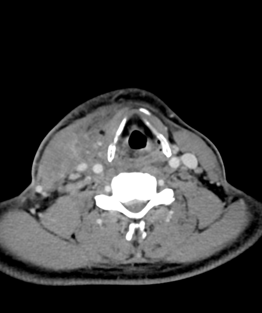 Cervical abscess (Radiopaedia 43725-47184 A 43).png