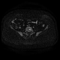 File:Cervical carcinoma (Radiopaedia 67644-77047 Axial DWI 2).jpg