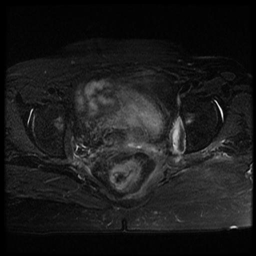File:Cervical carcinoma (Radiopaedia 70924-81132 Axial T2 fat sat 9).jpg