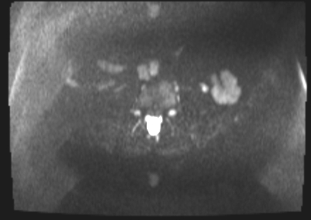File:Cervical carcinoma (Radiopaedia 88312-104943 Axial DWI 3).jpg