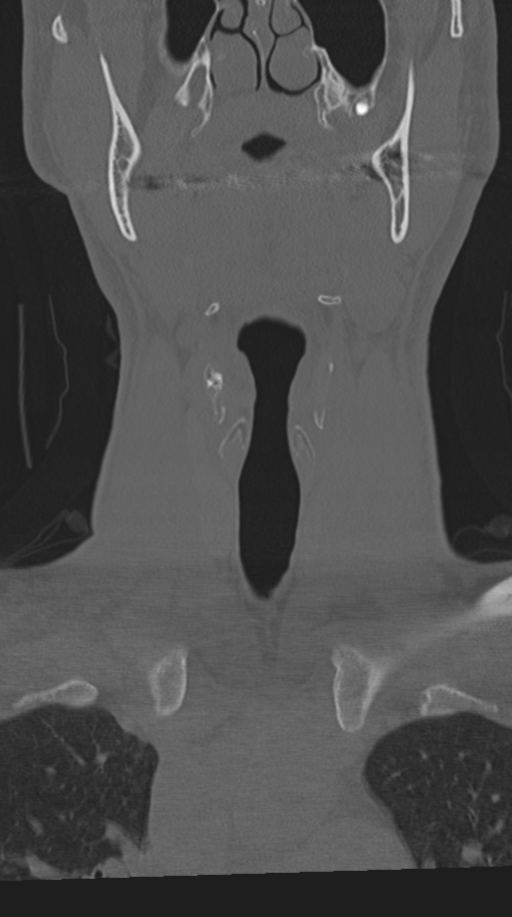 Cervical intercalary bone (Radiopaedia 35211-36748 Coronal bone window 11).png