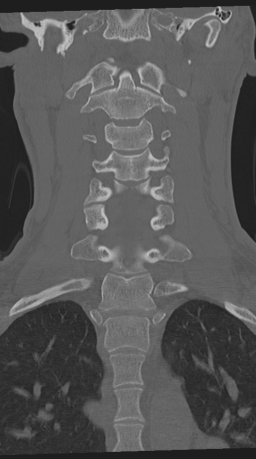 Cervical intercalary bone (Radiopaedia 35211-36748 Coronal bone window 37).png