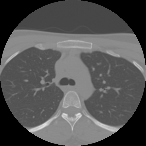 File:Cervical rib (Radiopaedia 71110-81363 Axial non-contrast 67).jpg