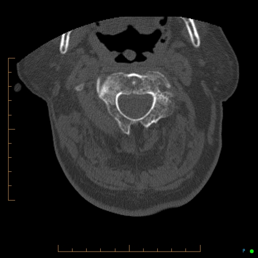 Cervical spine fracture - ankylosing spondylitis (Radiopaedia 76835-88706 Axial bone window 55).jpg