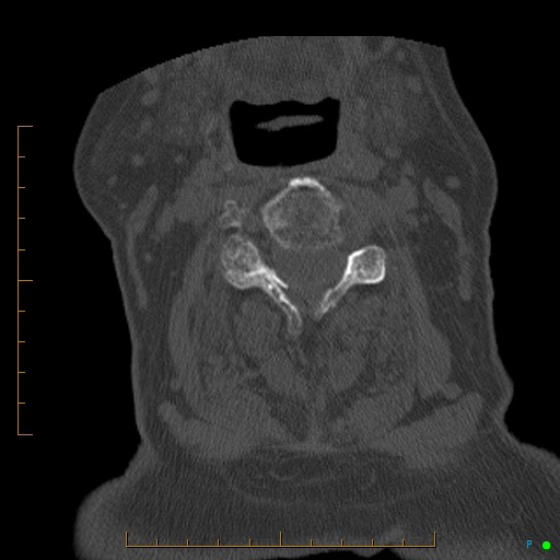 Cervical spine fracture - ankylosing spondylitis (Radiopaedia 76835-88706 Axial bone window 94).jpg