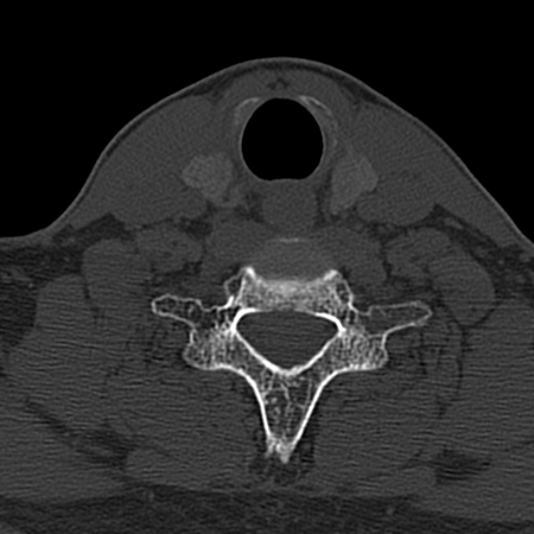 Cervical spondylodiscitis (Radiopaedia 28057-29489 Axial bone window 60).jpg