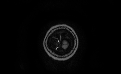 Cervical spondylodiscitis and calvarial hemangioma (Radiopaedia 64317-73103 Coronal T1 C+ 77).jpg