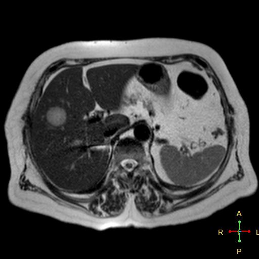 File:Cervical stump squamous cell carcinoma (Radiopaedia 48049-52858 I 10).jpg