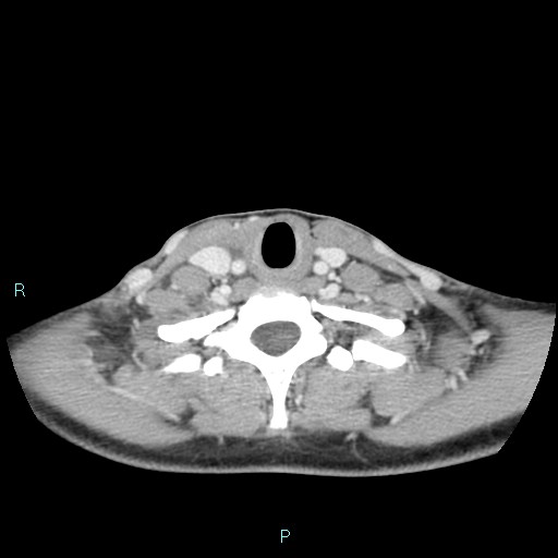 Cervical thymic cyst (Radiopaedia 88632-105335 C 40).jpg