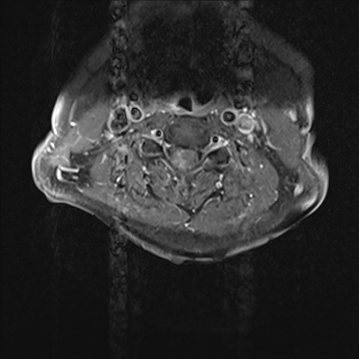 File:Cervical tumor-like myelopathy due to Type V dAVF (Radiopaedia 82461-96604 Axial T1 C+ fat sat 15).jpg
