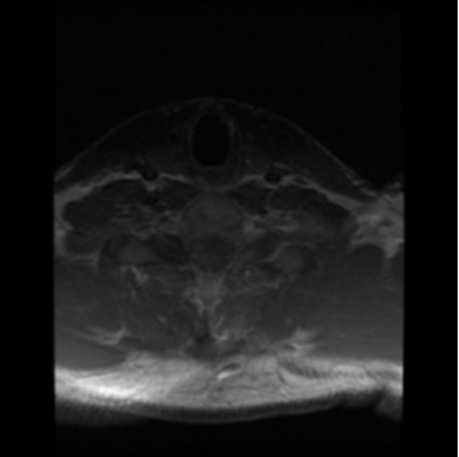 File:Cervical vertebrae metastasis (Radiopaedia 78814-91667 Axial T1 C+ 1).png