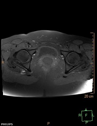 File:Cesarian scar endometriosis (Radiopaedia 68495-78066 Axial T1 fat sat 20).jpg