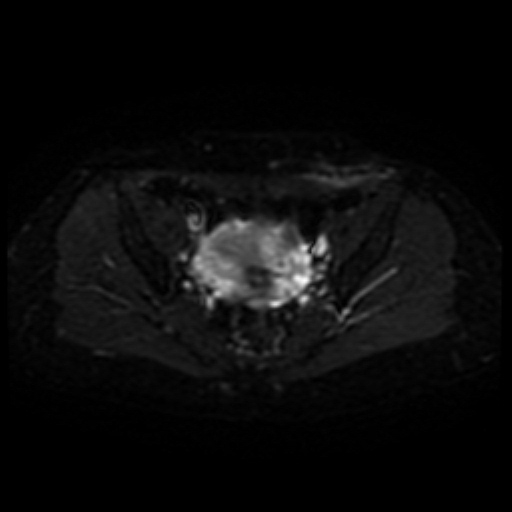 Cesarian section scar endometriosis (Radiopaedia 66520-75799 Axial DWI 11).jpg