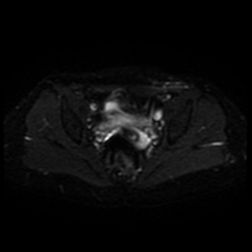 Cesarian section scar endometriosis (Radiopaedia 66520-75799 Axial DWI 13).jpg