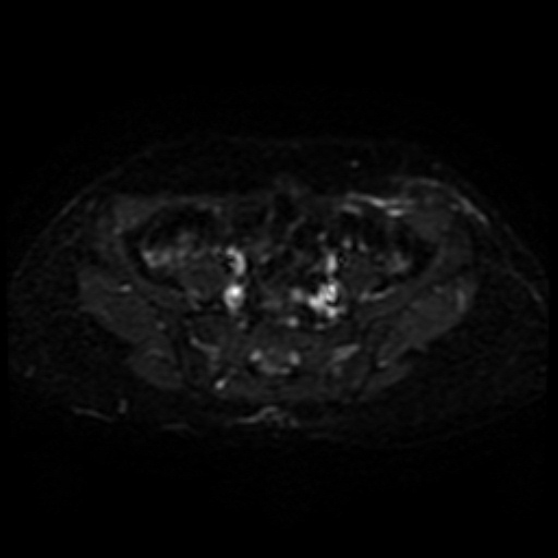File:Cesarian section scar endometriosis (Radiopaedia 66520-75799 Axial DWI 4).jpg