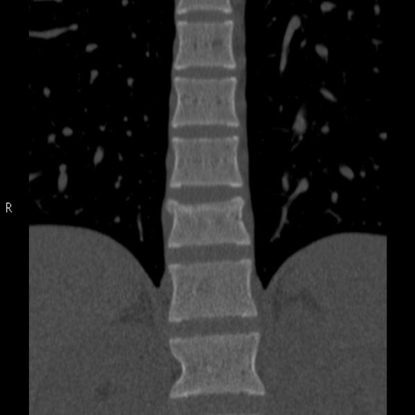 File:Chance fracture (Radiopaedia 36521-38081 Coronal bone window 15).jpg