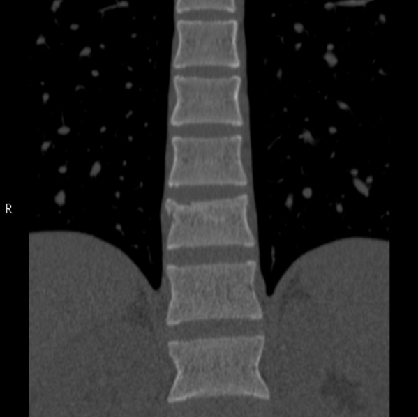 Chance fracture (Radiopaedia 36521-38081 Coronal bone window 19).jpg