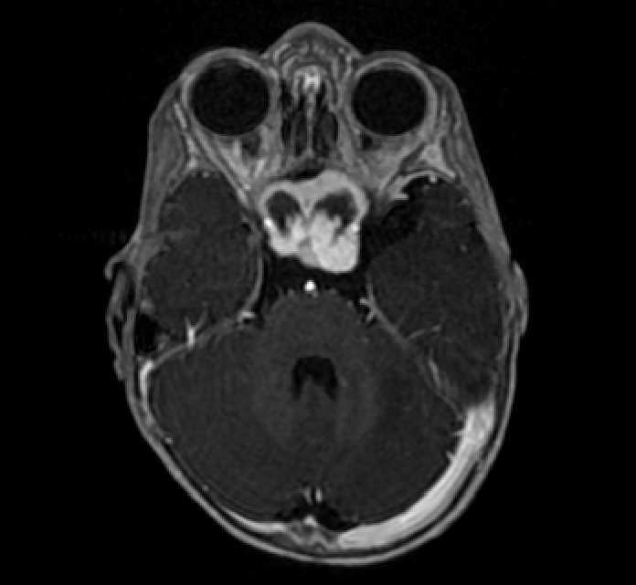 Chiasmatic-hypothalamic glioma (Radiopaedia 90079-107252 Axial T1 C+ 23).jpg