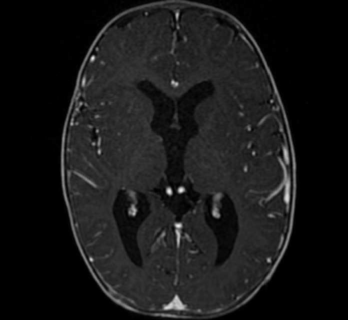 Chiasmatic-hypothalamic glioma (Radiopaedia 90079-107252 Axial T1 C+ 45).jpg