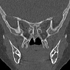 Choanal atresia (Radiopaedia 88525-105975 Coronal bone window 74).jpg